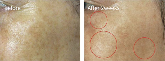 Before & After Pictures