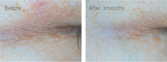 Before & After Pictures